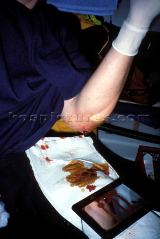 Injured Pete Goss operating on his own arm during the Vendee Globe 1996  1997